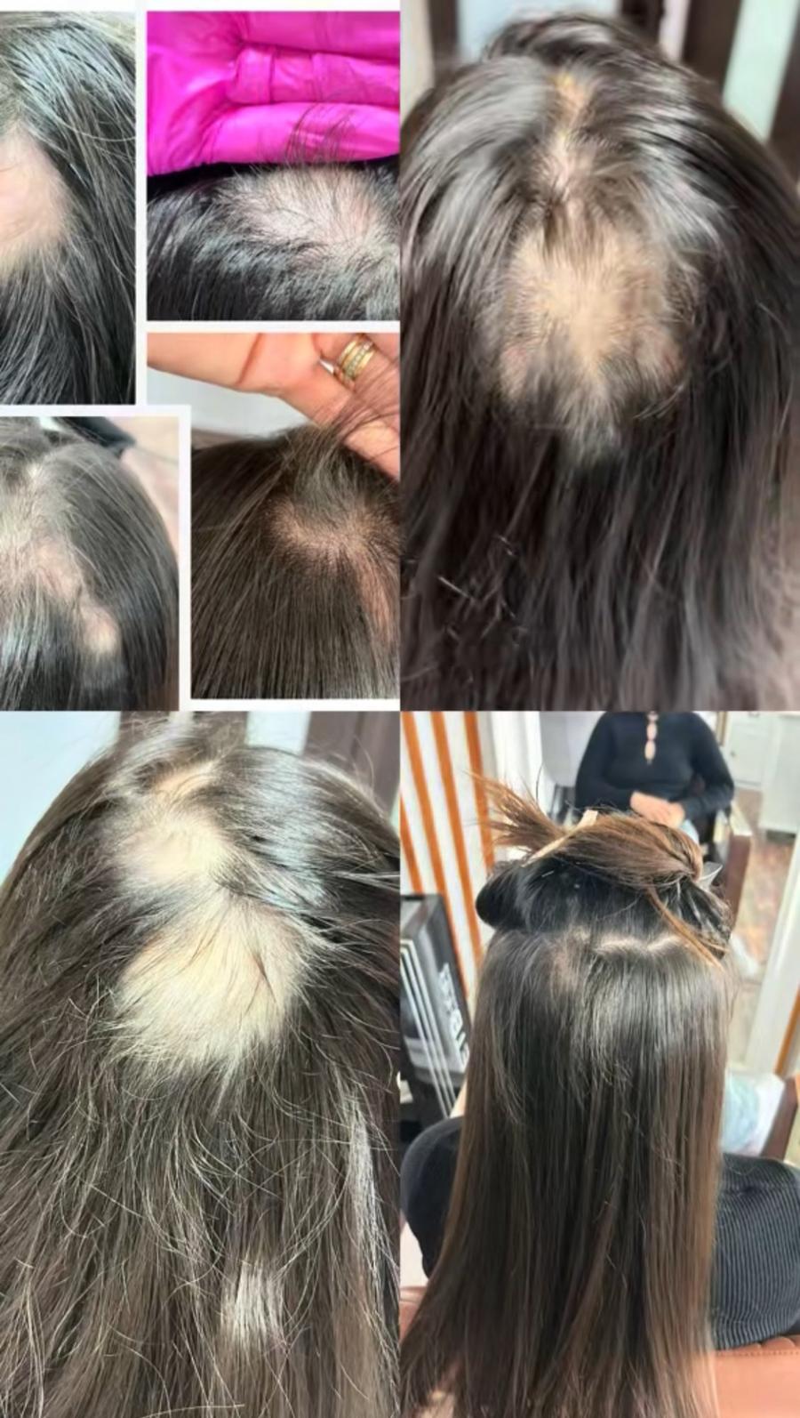 Colaj progres alopecie areată - înainte după tratament TRICOEXPERT Iași mezoterapie capilară
