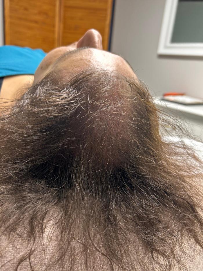 Alopecie androgenică feminină Vertex — rarefiere frontală și centrală cabinet TRICOEXPERT Iași