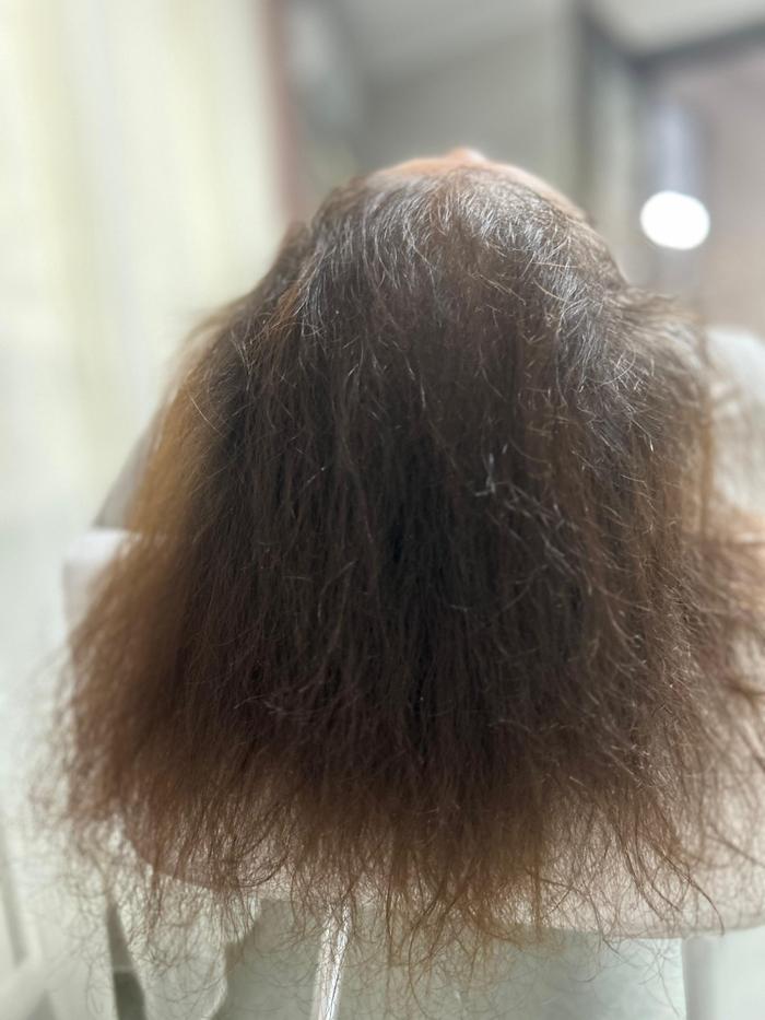 Alopecie androgenică feminină Firul de păr — subțiat, fragil cabinet TRICOEXPERT Iași